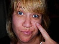 как лечить аллергию на лице