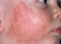 как лечить атопический дерматит