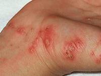 как лечить чесотку