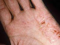 как лечить экзему на руках