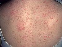 как лечить фолликулит