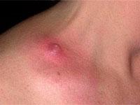 как лечить фурункулез