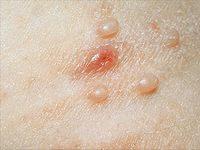 как лечить контагиозный моллюск