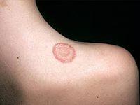 как лечить лишай у человека