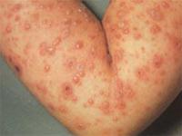 как лечить опоясывающий герпес