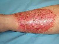 как лечить рожу на ноге