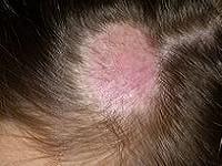 как лечить стригущий лишай