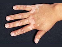 как лечить витилиго в домашних условиях