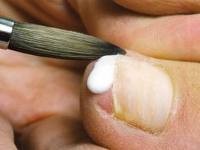 как лечить вросший ноготь