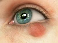 как лечить ячмень на глазу