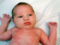 как проявляется краснуха у детей