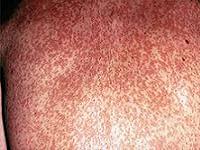 как проявляется краснуха у взрослых