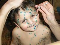 как проявляется ветрянка у детей