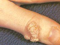 как удалить бородавку на пальце руки