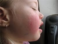 как вылечить диатез у ребенка