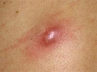 как вылечить фурункулез навсегда