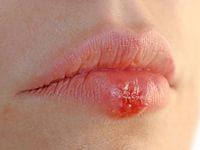 как вылечить герпес на губах