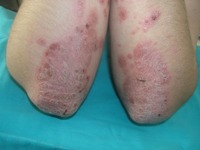 как вылечить псориаз