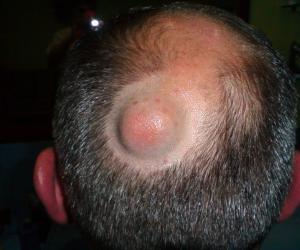 атерома волосистой части головы фото