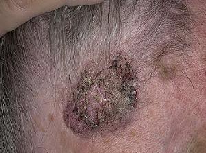 себорейная кератома фото