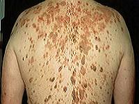 кератоз кожи