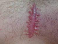 коллоидные рубцы