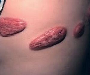 келлоидные рубцы фото