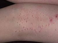 контагиозный моллюск лечение