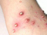 контагиозный моллюск