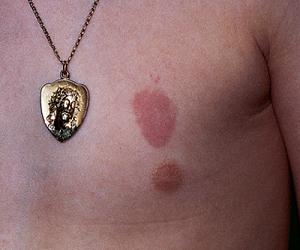 аллергический контактный дерматит фото