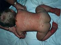 контактный дерматит у детей