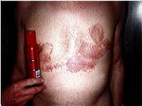 контактный дерматит