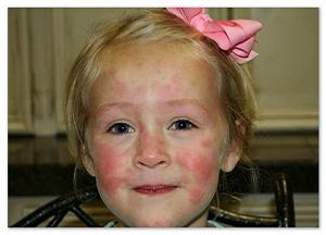 как выглядит крапивница у ребенка фото