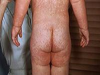 крапивница у детей