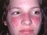 красная волчанка симптомы и лечение