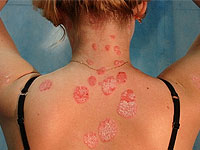 красный плоский лишай лечение народными средствами