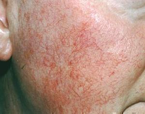 купероз на лице фото