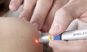 что такое купероз кожи лица фото