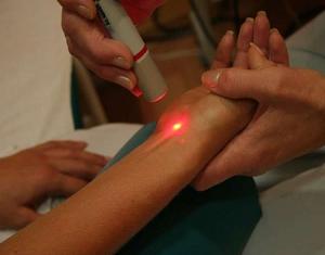 дерматофиброма лечение лазером фото