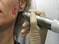 лечение акне на лице