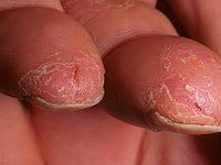 лечение экземы на пальцах рук