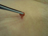 лечение фибромы народными средствами