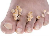 лечение грибка стопы в домашних условиях