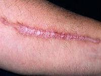 лечение коллоидных рубцов