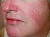 лечение купероза на лице