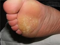 лечение натоптышей на ногах