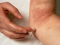 лечение нейродермита