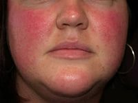 лечение розацеа на лице