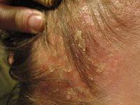 лечение себорейного дерматита