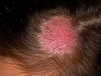 лечение цветного лишая у человека